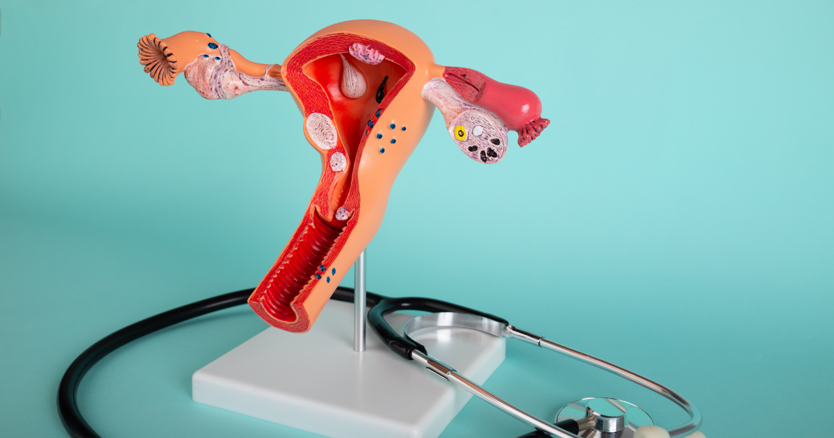 Endometriosis and Pelvic Floor PT